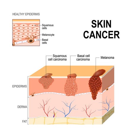 Skin Cancer Illustration